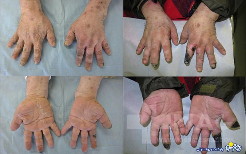 نکروز چیست و راههای درمان آن کدام است؟ نکروز چیست و راههای درمان آن کدام است؟